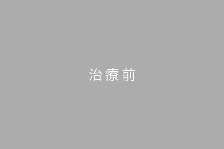 治療前